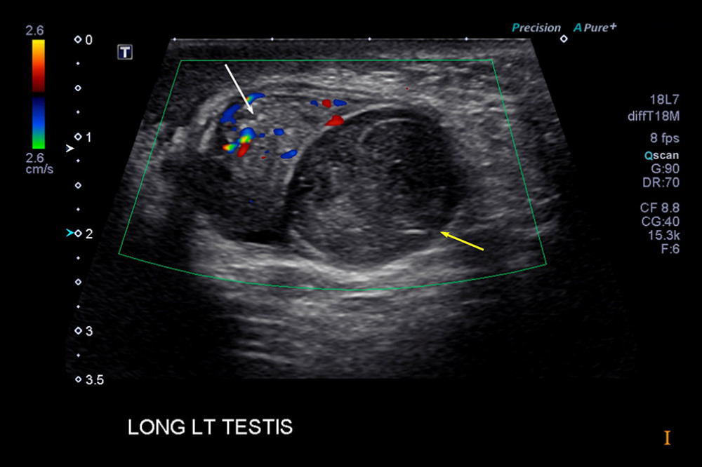 Longitudinal view of the left hemiscrotum shows a partially visualized left testicle (white arrow) with adequate internal vascularity on color Doppler sonography. Inferior and lateral to the described testicle is an oval heterogeneous predominantly hypoechoic structure showing no internal vascularity (yellow arrow).