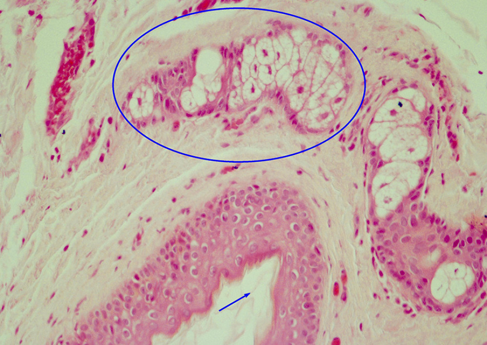 Low-power (20×) image of a cyst containing keratinous material lined by stratified squamous epithelium (arrow) with cutaneous adnexal structures (sebaceous glands, circle) in the fibroconnective tissue wall.