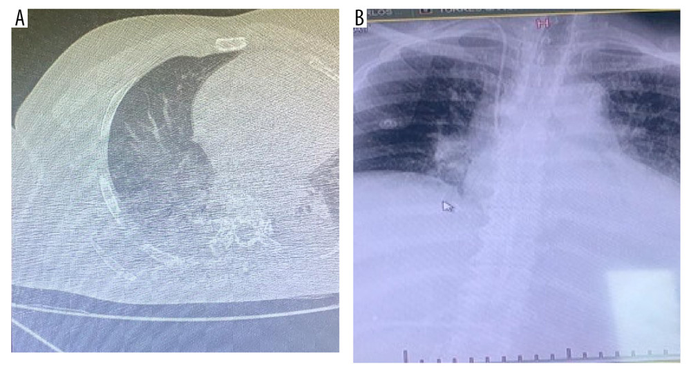 (A) Chest X-ray shows infiltrate of the right hilum and (B) shows opacity in both lung bases.