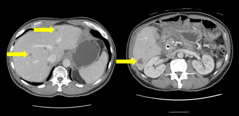 Computed tomography scan of the abdomen performed before starting immunotherapy showing multiple hepatic lesions consistent with pancreatic cancer metastases as shown using the arrows.