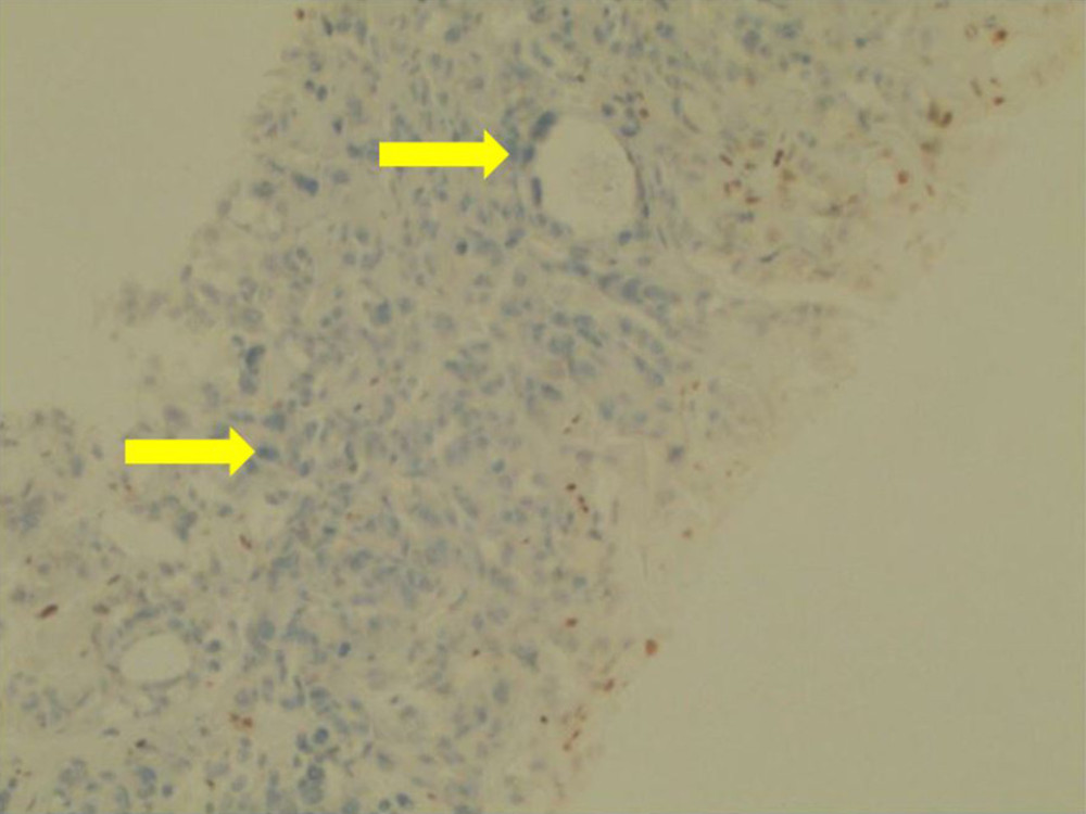 Immunohistochemistry of a liver biopsy specimen (hematoxylin and eosin stain, 100×) showing abnormal/lost expression of MLH1 protein as shown using arrows. Lymphocytes and normal epithelium exhibit strong nuclear staining and serve as positive internal controls for staining of this protein.