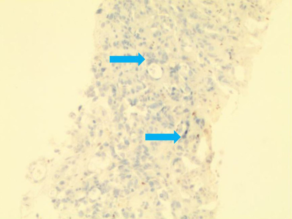 Immunohistochemistry of a liver biopsy specimen (hematoxylin and eosin stain, 100×) showing abnormal/lost expression of PMS2 protein as shown using arrows. Lymphocytes and normal epithelium exhibit strong nuclear staining and serve as positive internal controls for staining of this protein.
