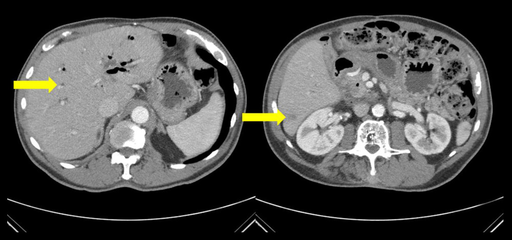 Computed tomography scan of the abdomen performed 7 months after 1 cycle of immunotherapy showing decreasing size of multiple hepatic lesions consistent with treatment response as shown using arrows.