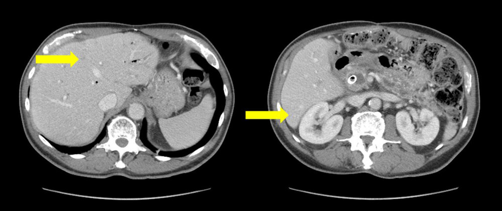 Computed tomography scan of the abdomen performed 11 months after 1 cycle of immunotherapy showing continued decrease and resolution of multiple hepatic lesions consistent with persistent treatment response as shown using arrows.