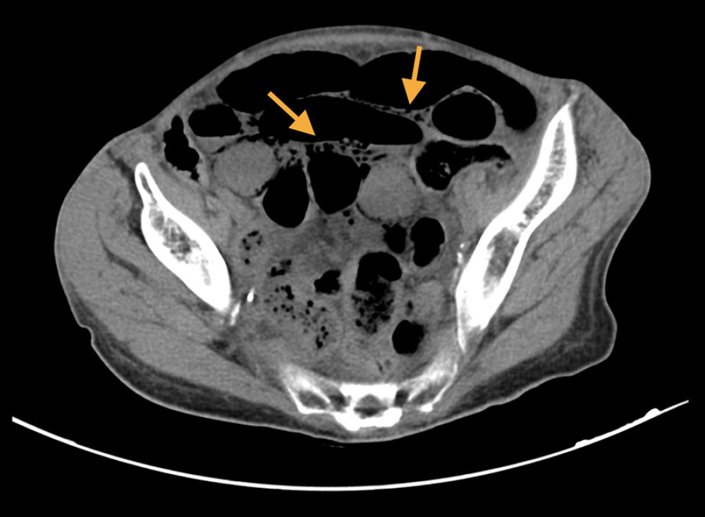 Arrows indicate the presence of air into the ileal loop wall.