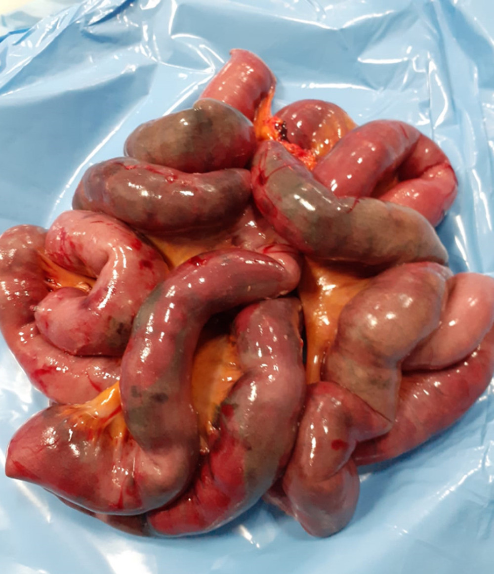 Resected bowel with signs of necrosis.