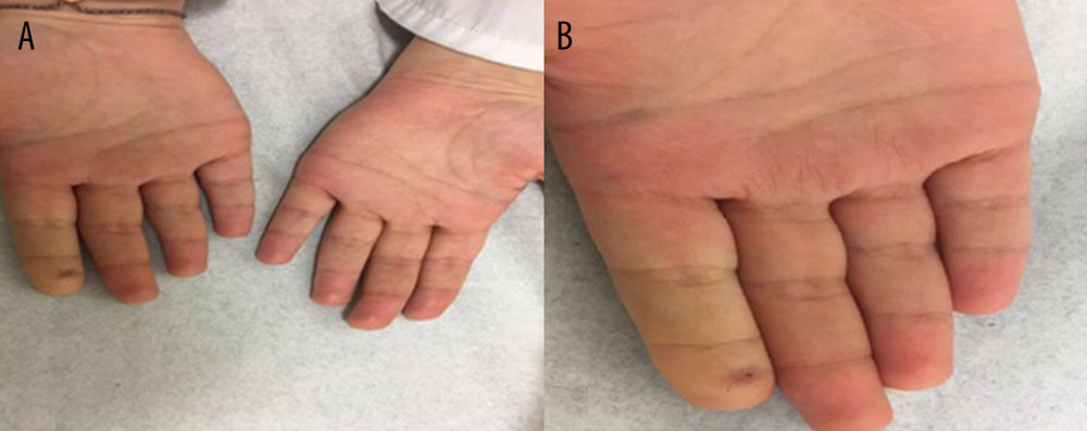 (A) Before starting the management, the right index finger was pale with a darkened puncture wound at the injection site. (B) Twenty minutes after the incident, the right index finger was still pale with a visible puncture wound at the injection point.