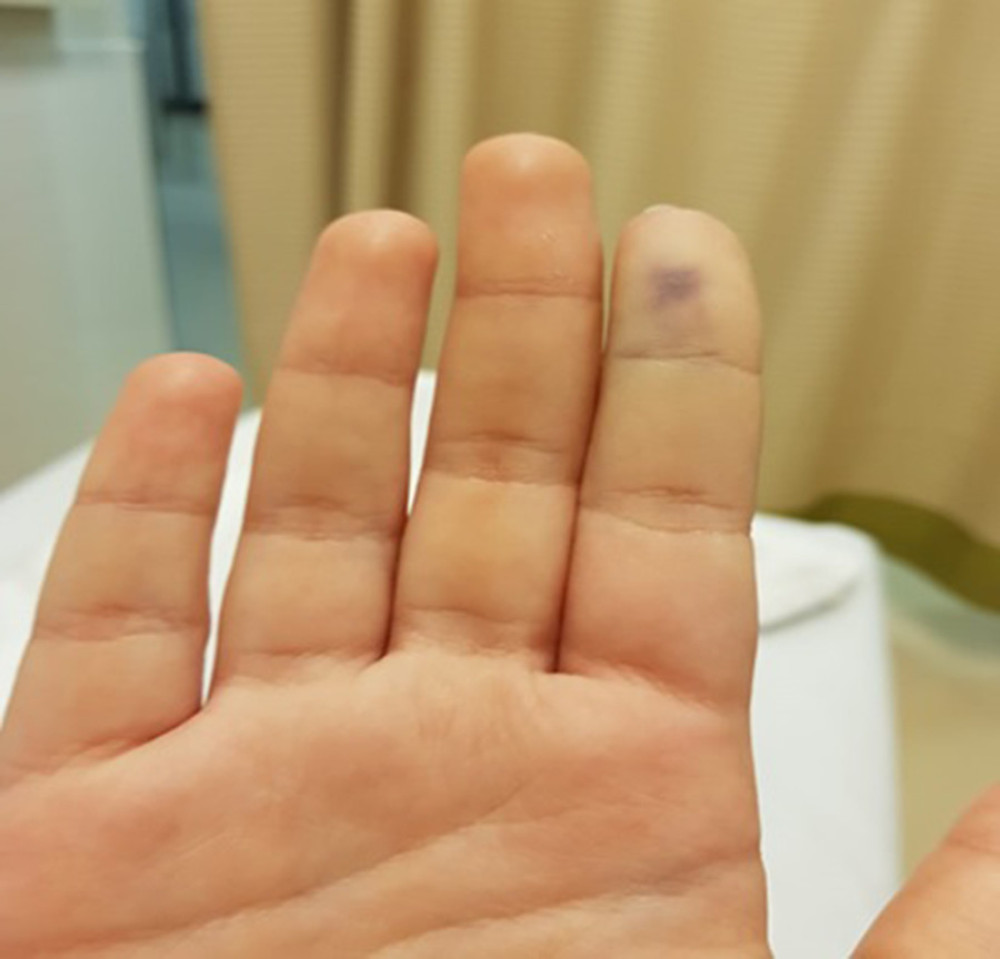 After immersion in water, the puncture wound at the tip of the right index finger had faded slightly.