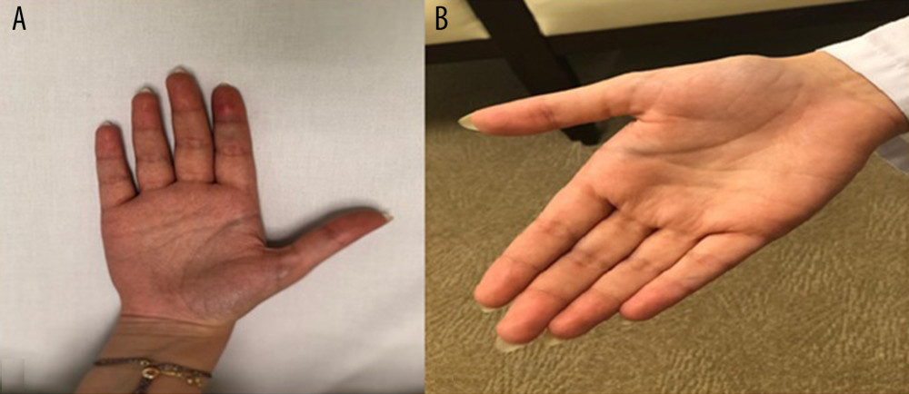 (A) Upon discharge, 6 hours after the incident, the right index finger had no pallor and slight hyperemia. (B) One month later, the right index finger appeared normal.