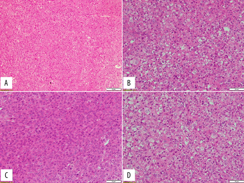 Hematoxylin-eosin staining of EA. The tumor consisted of large epithelioid cells with that were round to polygonal. It had central to eccentrically placed nuclei containing prominent nucleoli. The chromatin was peripherally marginated within the nucleus. The cells were basically arranged in sheets. Mitotic figures, including abnormal mitoses, were frequently seen (A: original magnification ×100; B–D: original magnification ×400).