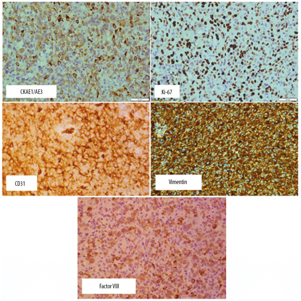 Images of immunohistochemical staining of EA (original magnification ×400). Malignant cells were diffusely positive for CD31, Factor VIII, and vimentin, and focally positive for CKAE1/AE3 and Ki67 (50%).