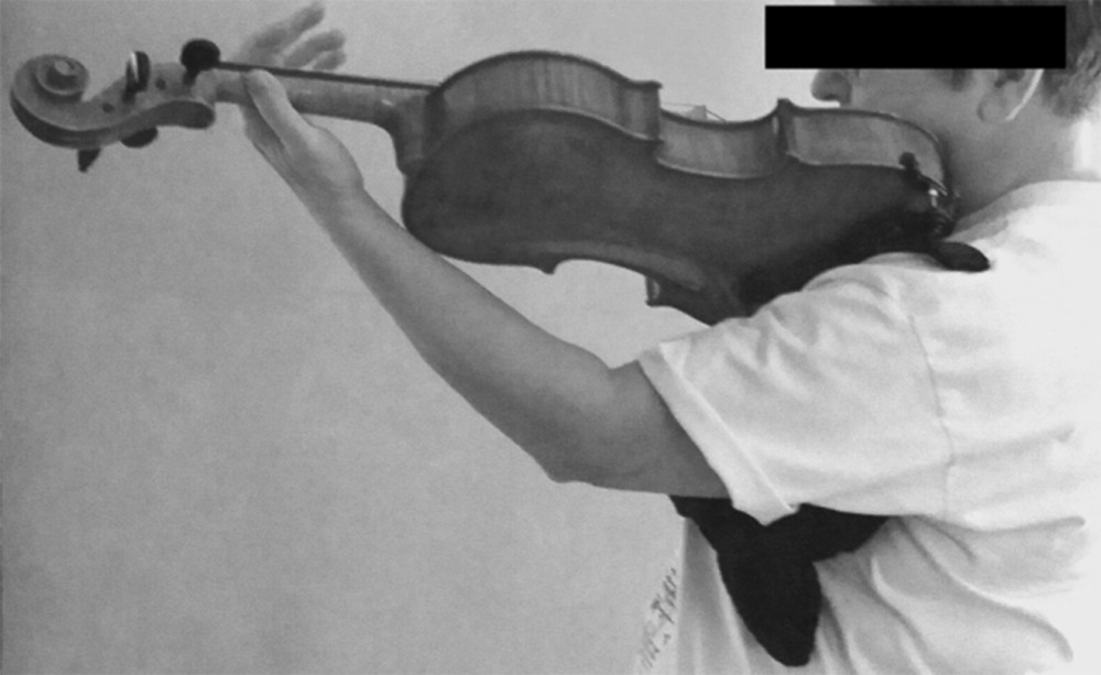 This violist depicts the use of a pillow under the left axilla to assist the effort of left arm abduction and external rotation. A healthy violist will not require assistance.