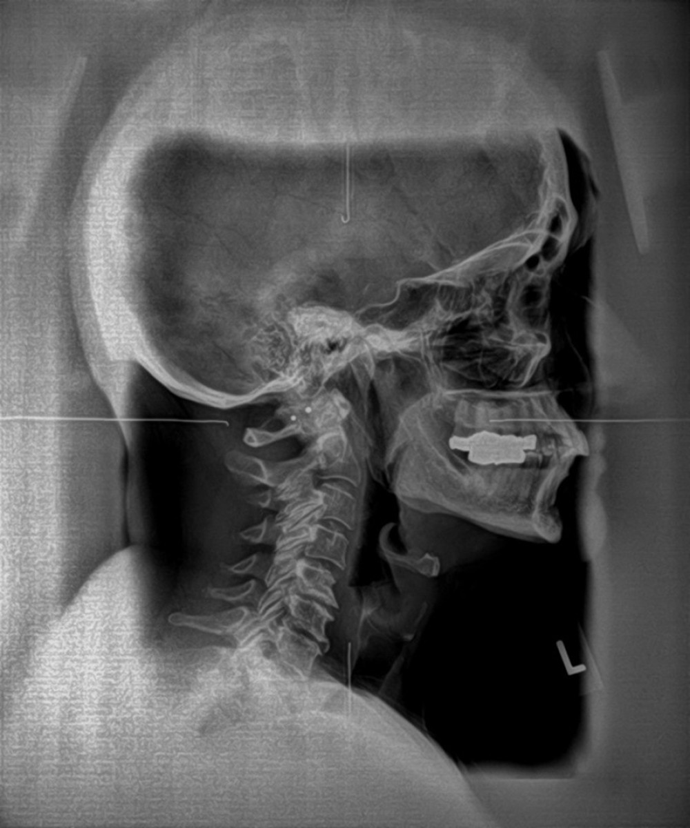 The lateral cervical radiograph shows ponticulus posticus on the atlas and degenerative joint disease throughout. The bucky has lead lines marking vertical and horizontal axes as true reference points for evaluating patient positioning.