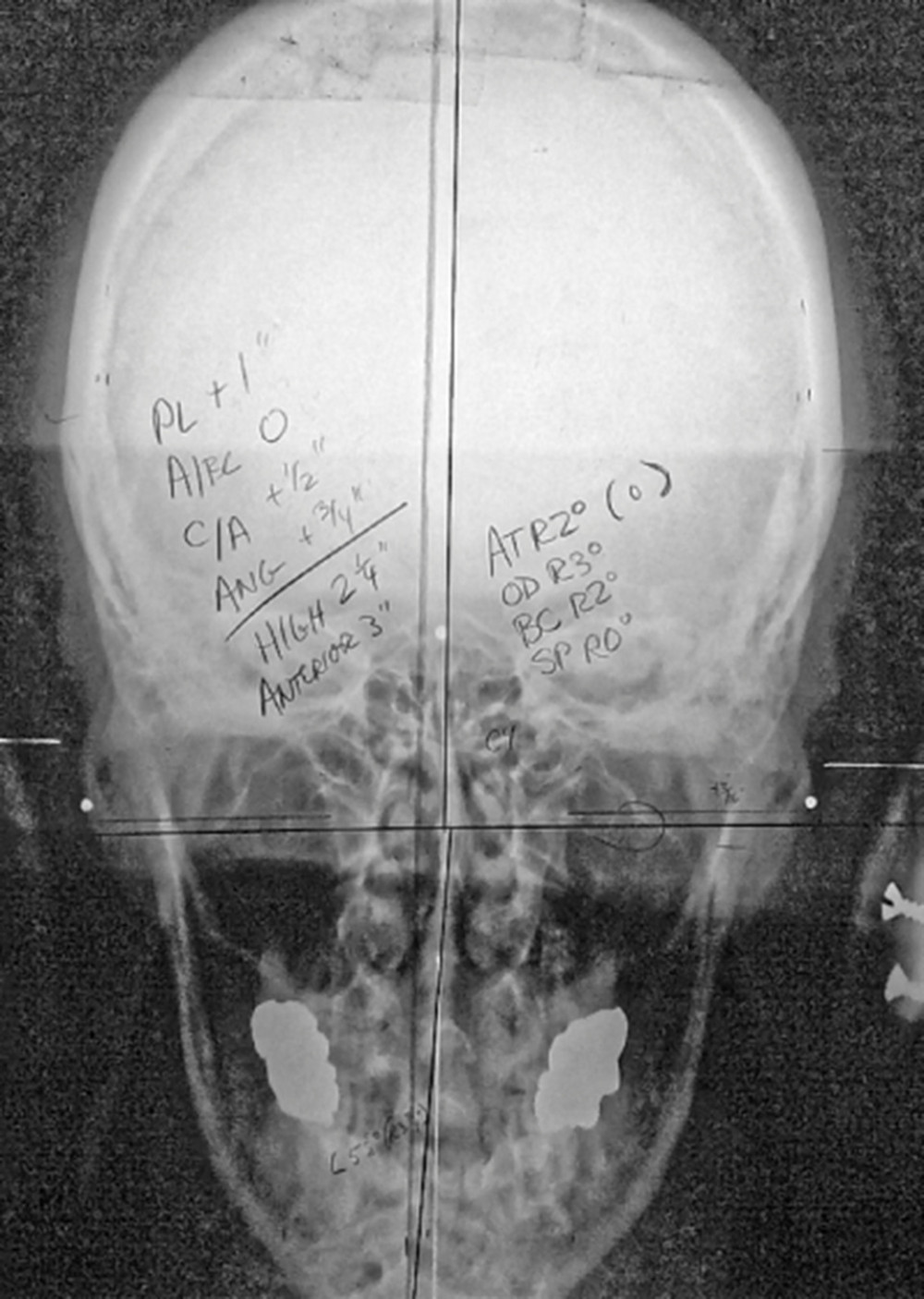 The frontal (nasium) radiograph depicts excursion of the cervical spine into the right frontal plane, creating an acute angle between the atlas (C1) and the skull (C0). The right side of the patient is on the right. On the right of the center line is recorded the elements of the misalignment: AT (atlas) right 2 degrees, OD (odontoid) right 3 degrees, BC (C2 body center) right 2 degrees, SP (spinous process of C2) right 0 degrees. To the left of center line is the calculated correction vector designed to restore the system to the vertical axis.