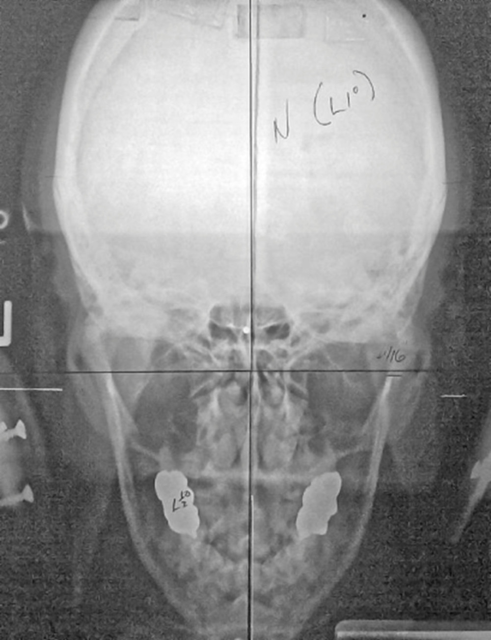 The post adjustment frontal (nasium) radiograph depicts the return of the cervical spine to the y-axis directly underneath the skull and effective reduction of the acute angle between the atlas and the skull. N (normal atlas-skull relationship), L1 (describes tilt of the head to the left 1 degree off the vertical axis, not a misalignment component).