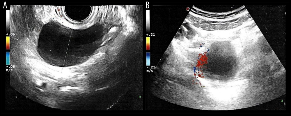 (A) Endocavitary ultrasound (US) (Philips Model No: iU22, Bothell, WA), showing an anechoic rounded mass with well-defined margins and measuring 64×44×54 mm, next to the right fallopian tube. (B) Color-Doppler module did not show any intralesional vascular signs.