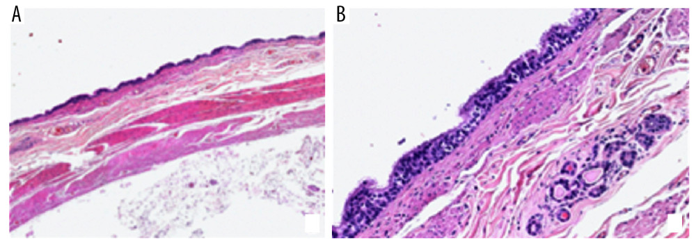 Histologic examination of the CIDC, showing (A) a duplicate wall composed of a mucosa, submucosa and a muscolaris propria with two muscular layers (H&E, 20×) and (B) lining epithelium made up of columnar pseudostratified ciliated cells with glands in the submucosa (H&E, 100×).
