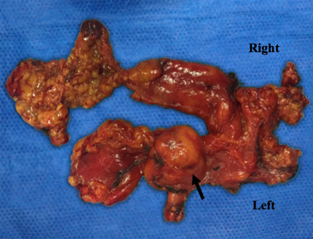 Gross appearance of completely resected thymus showing 2×2 cm size of well-demarcated thymolipoma lesion within the left lower horn of the thymus (arrows).