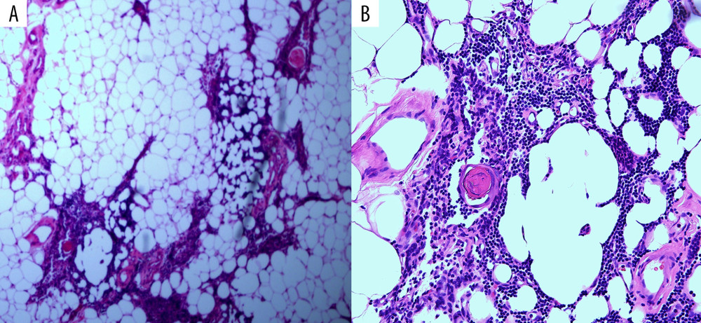 Hematoxylin and eosin stained section showing scattered variably sized islands of unremarkable thymic tissue within abundant mature adipose tissue. (A) Original magnification 40×. (B) Original magnification 200×.