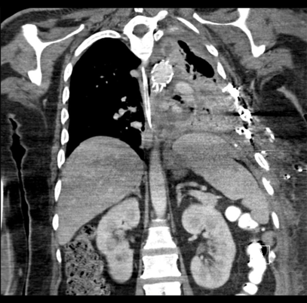 Postoperative chest computed tomography (CT) lacked the previous radiopaque line that was seen in the preoperative chest CT.