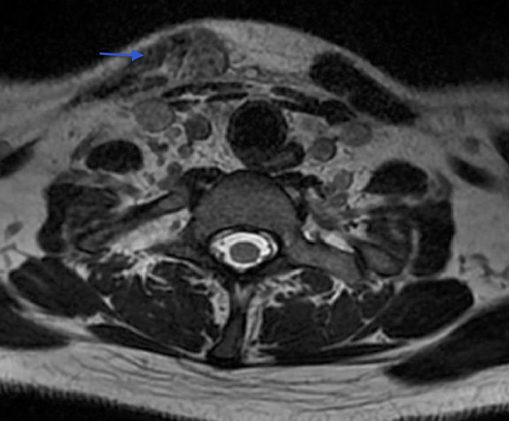 Cervical spine MRI without contrast reveals the edema and enhancement (arrow) of the right SCM compared with the left SCM; finding is consistent with inflammation.