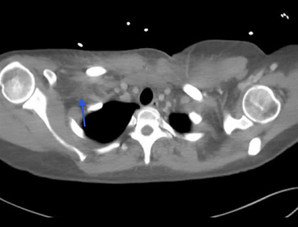 Shoulder CT with IV contrast reveals edema and fluid anterior to the right sternoclavicular joint with involvement of the right anterior thorax (arrow).