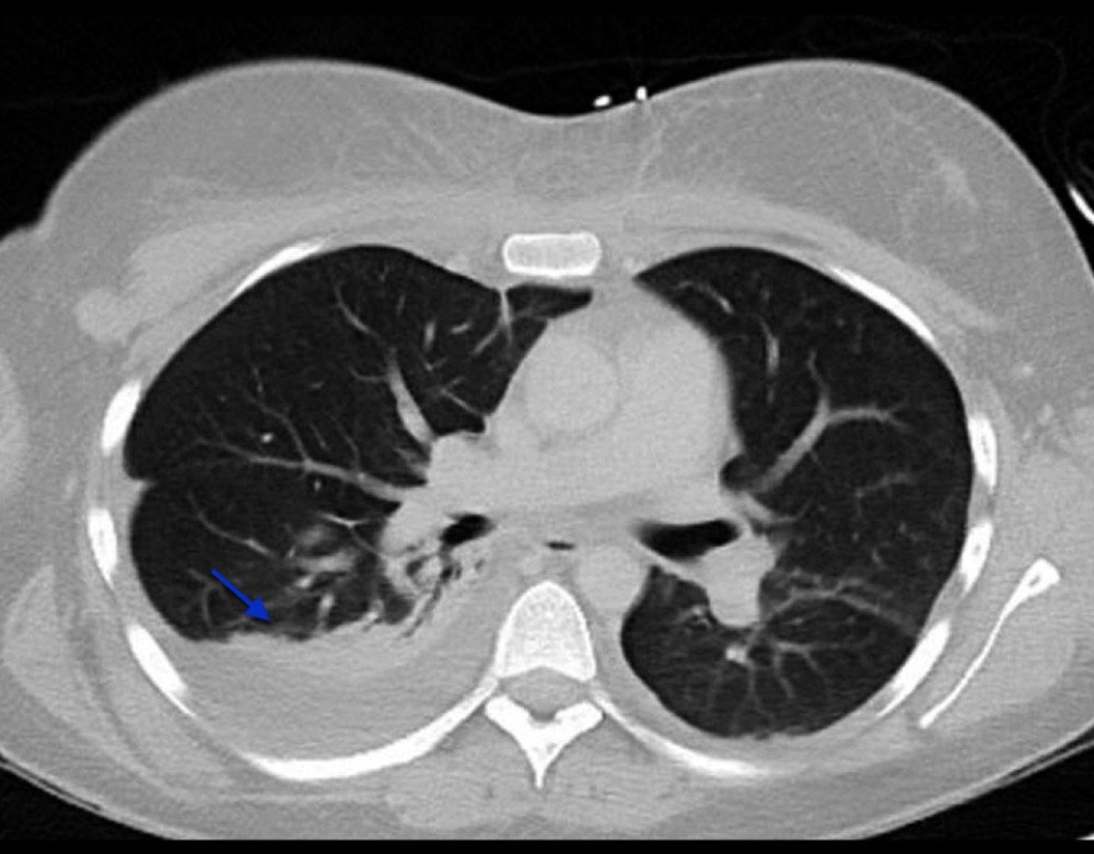 Chest CT with IV contrast reveals right basilar opacification (arrow).
