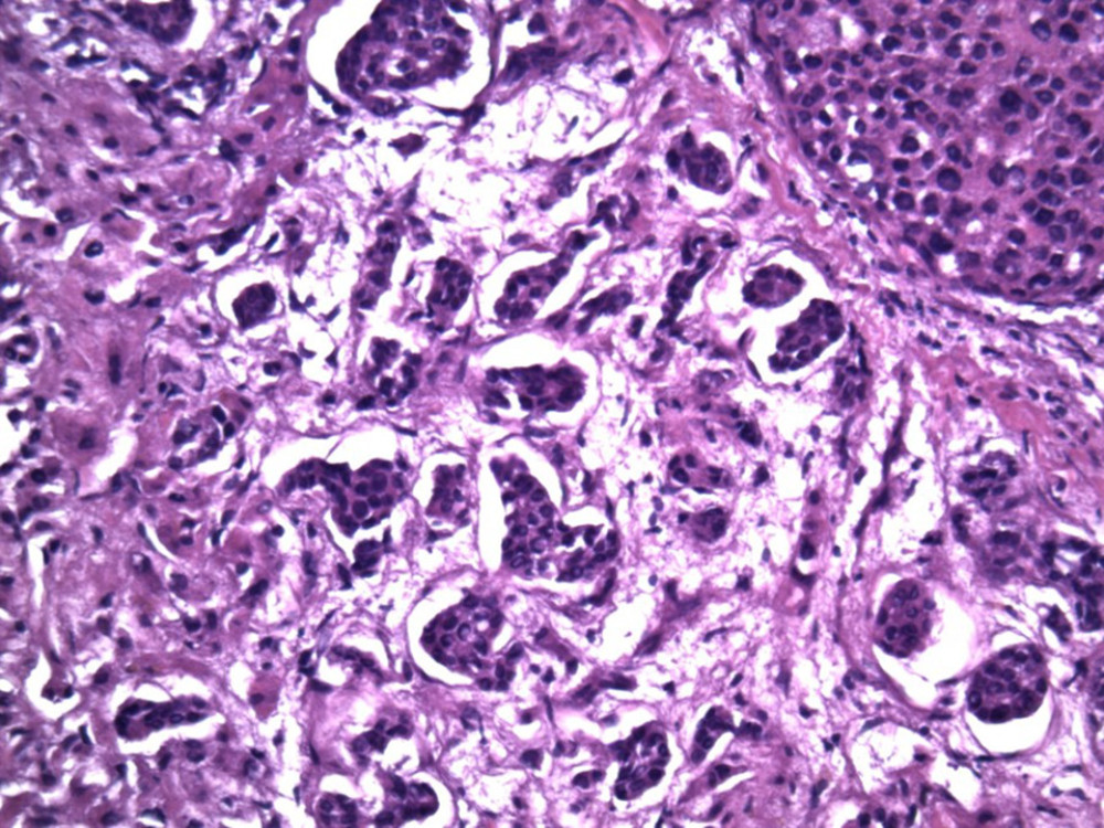 Metastatic carcinoma diffusely infiltrating hepatic sinusoids (hematoxylin-eosin, original magnification ×200).