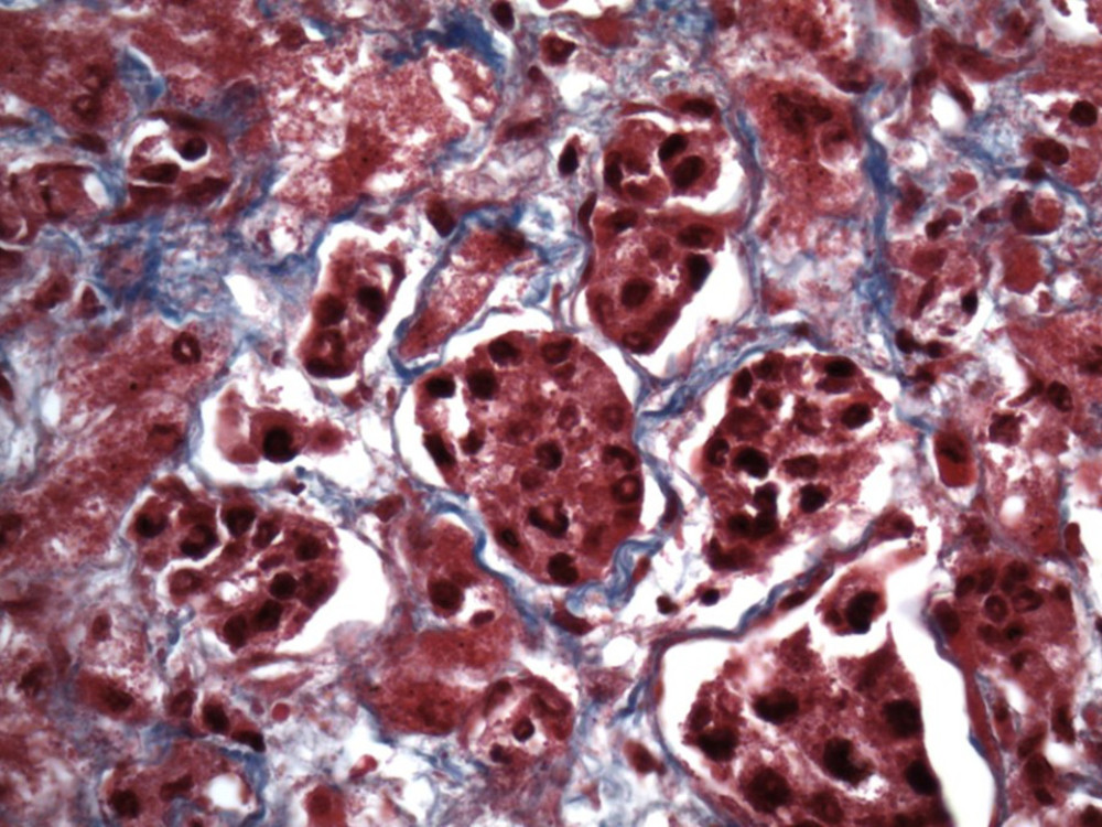 Trichrome special stain highlights sinusoids (blue) surrounding the tumor emboli (original magnification ×400).