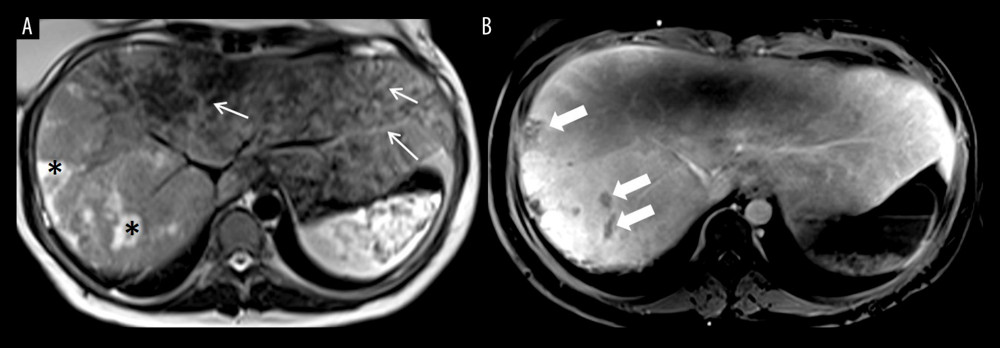 MRI of the abdomen, 3/10/19. (A) Axial T2 weighted image demonstrates diffusely and somewhat linear increased T2 signal in the right and left hepatic lobes (thin arrows). Note more confluent areas of increased signal in the right hepatic lobe indicating edema/necrosis (*). (B) Axial T1 post contrast image shows heterogeneous enhancement of the liver with areas of hypo-enhancement (thick arrows) suggesting underlying ischemia.