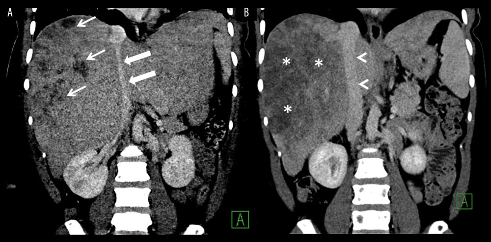 CT of the abdomen with IV contrast, coronal images. (A) 03/13/19 CT showed hypo-enhancement areas in the right hepatic lobe due to ischemia or tumor infiltration (thin arrows). Note compression of intrahepatic IVC (thick arrows). (B) 4/12/19 Follow-up CT with improved hepatomegaly with less compression of intrahepatic IVC (Arrow heads). Note more organized hypo-enhancement of the liver related to infiltrative process (*).