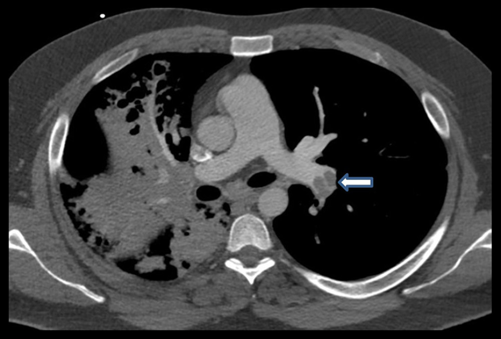 Computerized tomography scan of the chest obtained on hospital day 8. Arrow indicates multiple clots in the left lower lobe pulmonary artery.