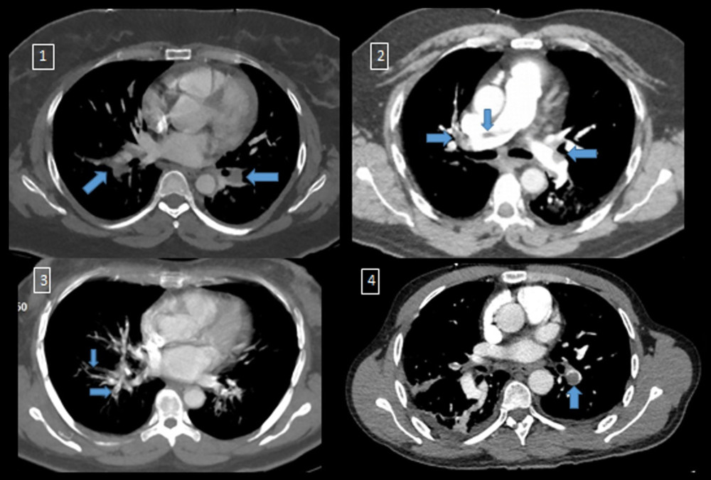 Composite of computerized tomography angiograms of cases 1–4. Numbered images correspond to numbered cases in Table 1. Arrows indicate sites of emboli.