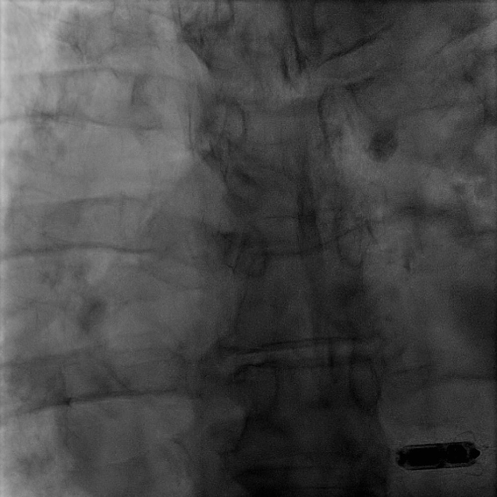 Leadless pacemaker. Micra leadless pacemaker (Medtronic Inc., Minneapolis, MN, USA) positioned in the right ventricular apex.