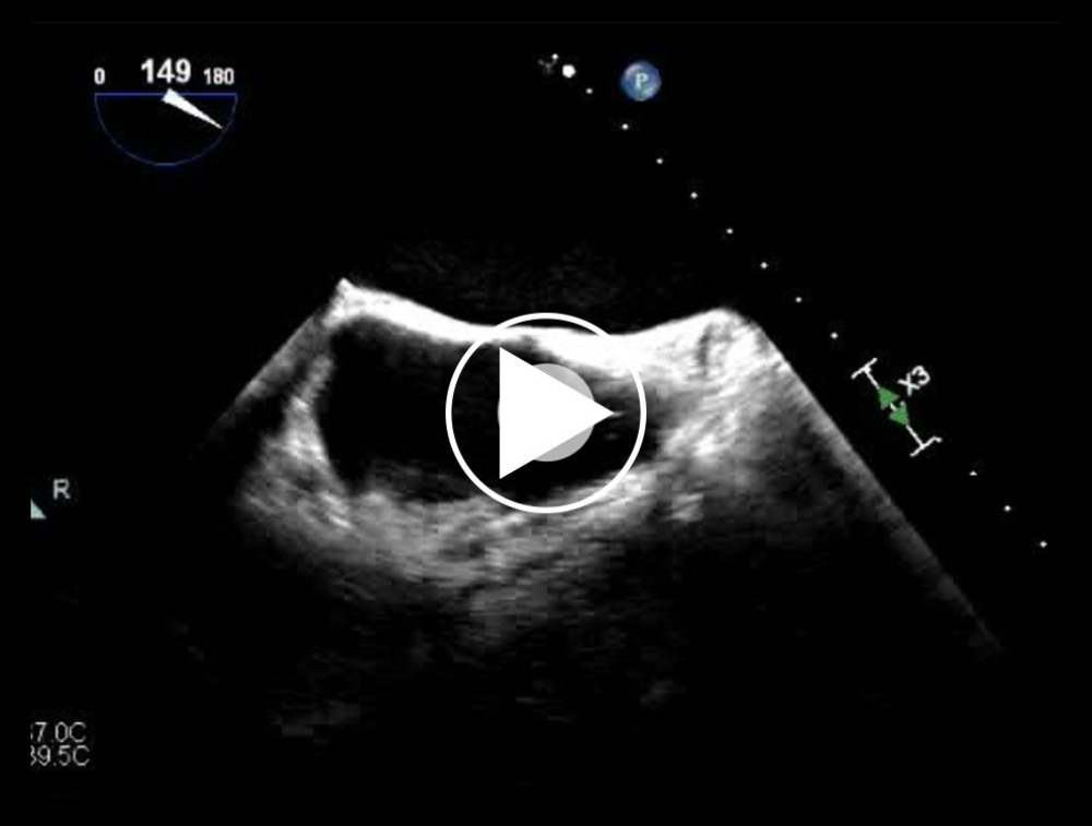 Transesophageal echocardiogram reveals the “ghost” as a mobile echo-dense mass in the right atrium.