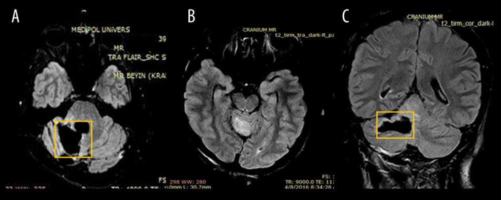 Postoperative magnetic resonance imaging (MRI) scans of the patient. (A) MRI transverse flair sense on March 20, 2017. (B) T2 turbo inversion recovery magnitude (tirm) transverse dark fluid. (C) T2 tirm coronal dark fluid MRI on March 8, 2016. The cerebellum has a parenchymal defect secondary to the operation in the right half and a hyperintense area consistent with gliosis (A). There is an area of approximately 2.5×1.5×2.5 cm with a dysplastic-benign neoplastic residue extending in the right half of the cerebellum in the upper medial lobe.