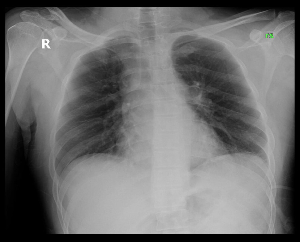 A CXR with an anterior-posterior view on day 0 at 0829 h – clear lungs.