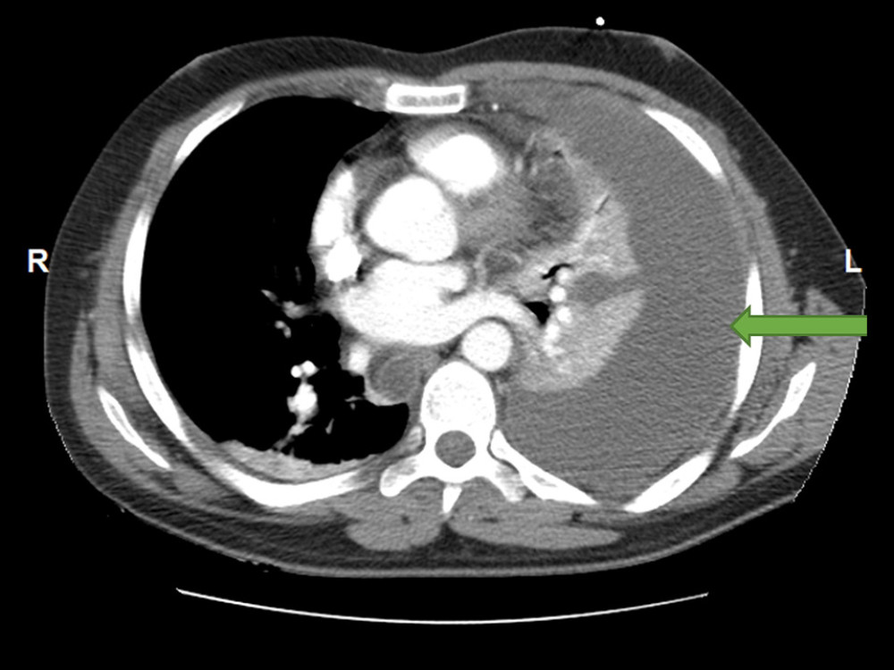 A chest CT on day 2 at 0912 h – a very large left pleural effusion (green arrow).