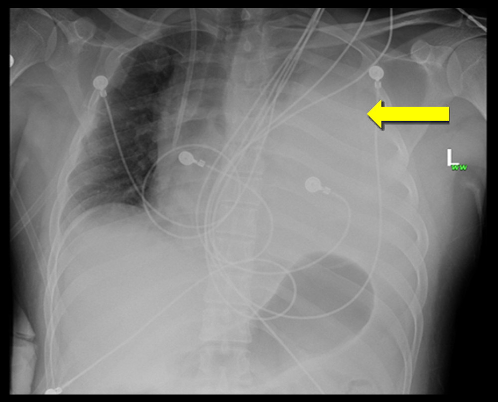A CXR with an anterior-posterior view on day 2 at 0930 h – a large left pleural effusion (yellow arrow).