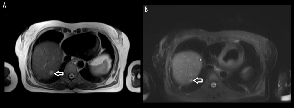 Hyperintensity of the lesion in T2-weighted imaging: (A) without fat saturation, (B) with fat saturation.