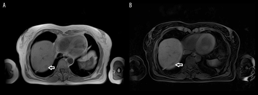 Hypointensity of the lesion in T1-weighted pre-contrast imaging: (A) in-phase, (B) with fat saturation.