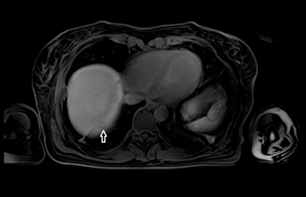 Unspecific homogenous uptake of Gd-BOPTA in the hepatobiliary phase 70 minutes after administration of the contrast agent. The lesion demonstrates “target sign” – hyperintensity in the central area and hypointensity in the surrounding rim.