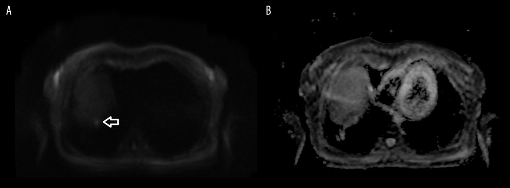(A) Moderate hyperintensity of the lesion in diffusion weighted imaging (DWI at b=800 s/mm2) and (B) inconclusive apparent diffusion coefficient (ADC) result in ambiguity in diffusion assessment.