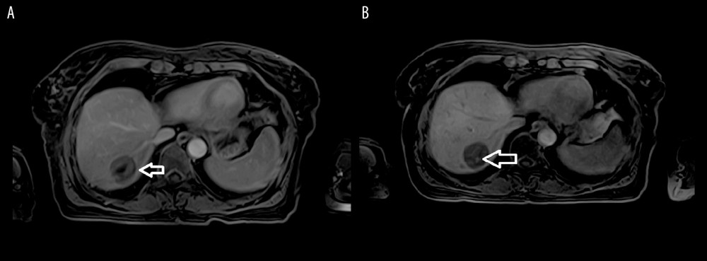T1-weighted fast field echo with fat suppression shows still visible primary lesion: (A) right after the administration of hepatospecific contrast media, (B) with Gd-BOPTA enhancement after 70 minutes.