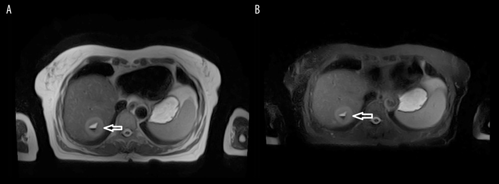 T2-weighted imaging shows moderate hyperintense lesion with markedly higher signal in the center: (A) image without fat saturation, (B) image with fat saturation.