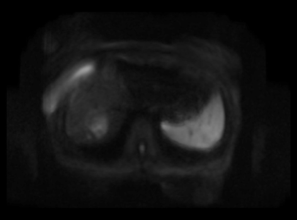 Irregular hyperintensity of the primary lesion in DWI (b=800 sec/mm2).