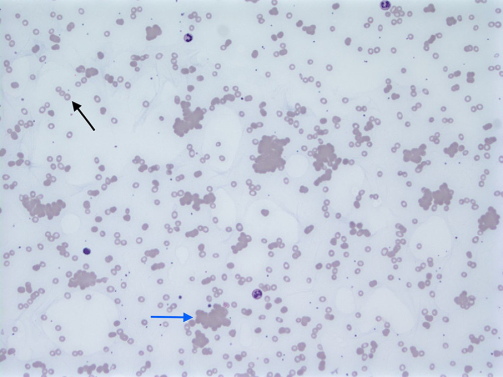 Peripheral smear showing agglutination and faint polychromasia. Stained with Wright-Giemsa. 200× magnification.