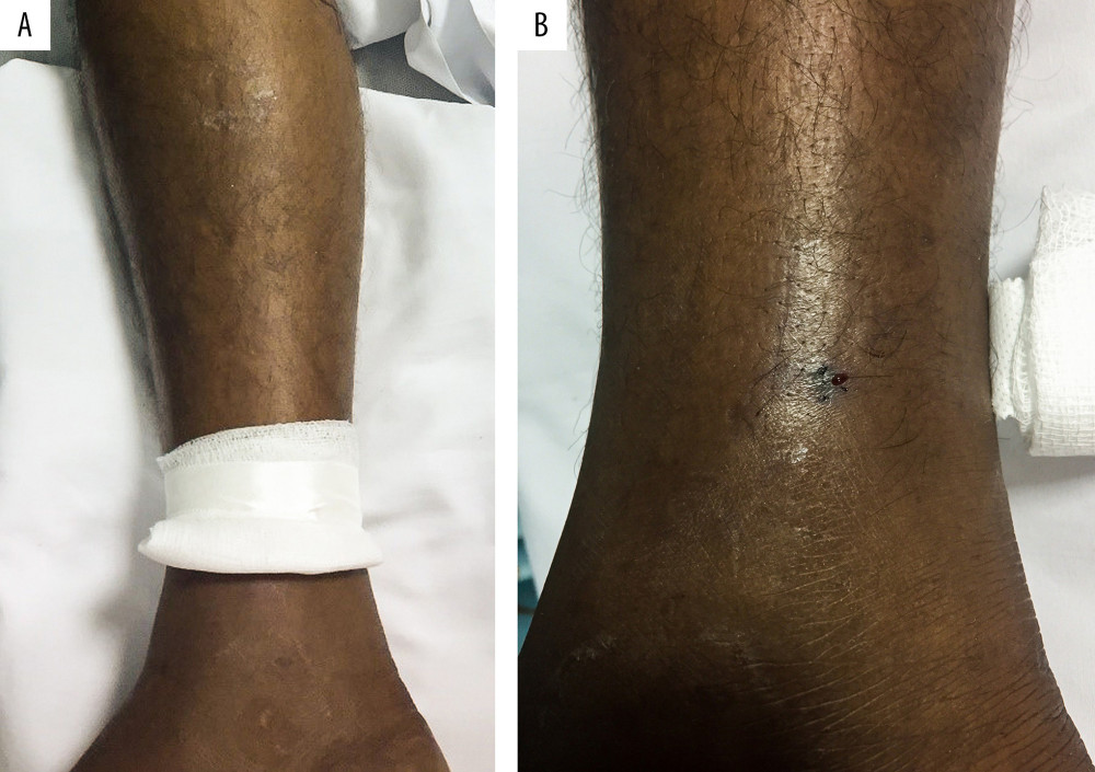 Bite location proximal to the medial right ankle (A) with close-up photo (B) showing minimal local swelling (photos were taken 5 h postenvenomation). (A) Bite location at the medial distal right lower extremity. (B) Foot/distal extremity is at the down of the image.