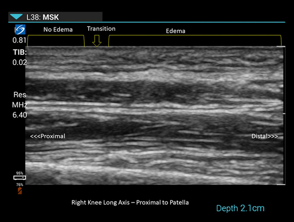 Point-of-care ultrasound of right thigh: demonstration of the transition zone from nonedematous thigh to area of subcutaneous edema (proximal end of the extremity is at the left of the figure).