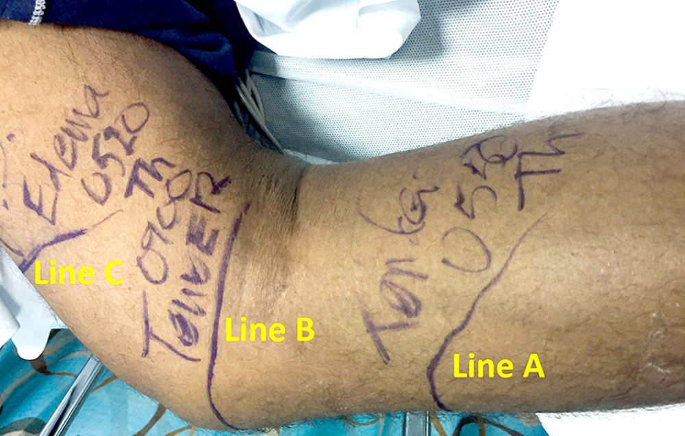 Skin markings on the right lower extremity (medial aspect) above and below the knee (the patient’s foot is toward the figure’s right side).